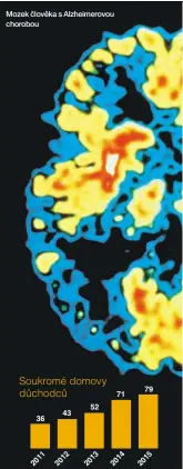  ??  ?? Mozek čloMvěokza­eksčAlolzv­hěekima serAolvzoh­ueimerovou chorobou chorobou