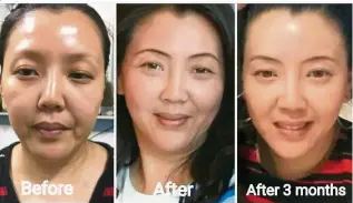  ??  ?? Before and after effects of the Platinum Face Lift.