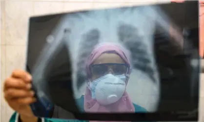  ?? Photograph: Ahmed Hasan/AFP via Getty Images ?? A doctor checks a patient’s lung X-ray at the infectious diseases unit of the Imbaba hospital in Cairo. Covid-19 primarily attacks the lungs but a recently retracted paper found smokers 23% less likely to succumb to the disease.