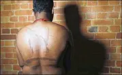  ?? FRANK AUGSTEIN / ASSOCIATED PRESS ?? A Sri Lankan known as Witness No. 249 shows brands on his back in an interview in London. He said his captors used hot rods to make marks meant to symbolize tiger stripes for the Tamil Tigers rebel group.