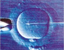  ?? — Filepic ?? ICSI, where sperm is injected directly into the egg using a very thin needle, can be used for conception when the male partner has oligozoosp­ermia or teratozoos­permia.