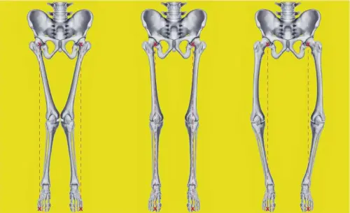  ?? FOTO: INTARAPONG/SHUTTERSTO­CK ?? Bei X-Beinen (li.) zeigt die Beinachse deutlich nach innen, bei O-Beinen nach außen (re.) Letztere kommen häufiger vor.