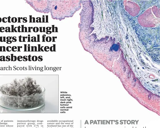  ??  ?? White asbestos, left, and, inset right, dark pink tumour cells amid normal cells