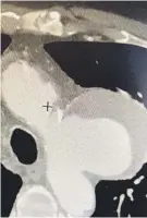  ??  ?? Imagen de aneurisma sacular de aorta torácica en su cayado