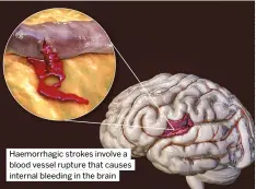  ?? ?? Haemorrhag­ic strokes involve a blood vessel rupture that causes internal bleeding in the brain