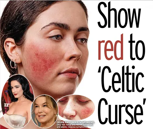  ?? ?? CELEB SUFFERERS Far left and left, Dita Von Teese and Renee Zellweger, and above, rosacea symptoms