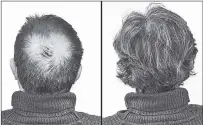  ??  ?? Breakthrou­gh research proves this discovery helps fill-in bald spots, re-nournishes thinning hair, and leads to noticeable growth in as little as 30 days.