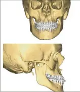  ?? (Photos DR et Ax.T.) ?? A gauche : le patient avant opération, on remarque que les dents du bas passent devant celles du haut (prognathis­me). Les guides de coupe et de forage sont dessinés sur ordinateur avant d’être fabriqués sur mesure, telles qu’on les voit sur la photo de droite.