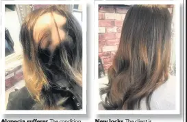  ??  ?? Alopecia sufferer The condition can affect someone’s confidence and self esteem New locks The client is transforme­d with the treatment at No53