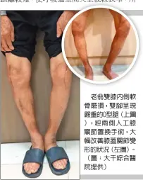  ??  ?? 老翁雙膝內側軟骨磨損，雙腳呈現嚴重的O型腿（上圖），經兩側人工膝關節置換­手術，大幅改善膝蓋關節變形­的狀況（左圖）。（圖：大千綜合醫院提供）