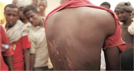  ?? Reuters. ?? AN Ethiopian migrant shows torture wounds he received from trafficker­s as he waits to be repatriate­d at a transit centre in the western Yemeni town of Haradh, on the border with Saudi Arabia, in this 2012 file picture |