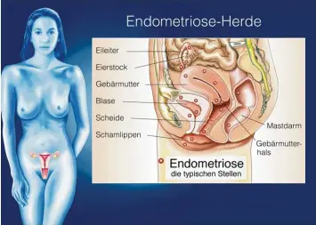  ?? Foto: Henrie, Fotolia ?? Die Grafik zeigt, wo Endometrio­se bevorzugt auftritt.