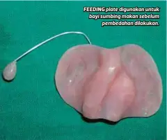  ??  ?? FEEDING plate digunakan untuk bayi sumbing makan sebelum
pembedahan dilakukan.