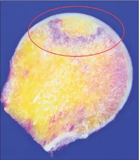  ?? Yale Medicine / Contribute­d photo ?? An image of a femoral head (the ball at the top of the femur) shows where a region of the blood supply has suffered from vascular necrosis.