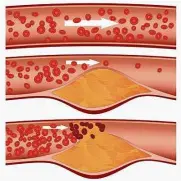  ??  ?? High cholestero­l, particular­ly high levels of ldl, can lead to the developmen­t of fatty deposits in blood vessels. — TnS