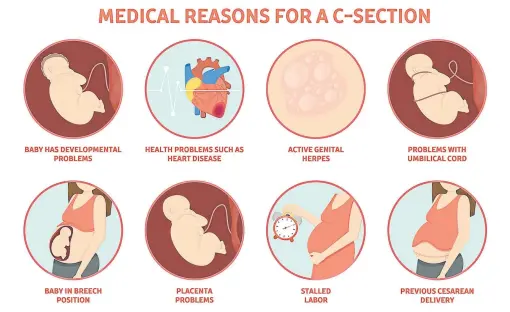  ??  ?? WHY C-SECTION? There are many medical reasons for a caesarean delivery, including stalled labour and problems with the placenta.