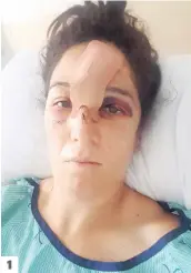  ?? PHOTOS TIRÉES DE FACEBOOK ?? 1 1. Alanda Packer, 30 ans, est alitée à l’hôpital avec un gros pansement sur le front, après son accident de VTT du 7 septembre dernier. 2. On voit ici son genou droit très enflé. 3. La jeune femme était en santé en compagnie de son copain à Niagara Falls, en août dernier.