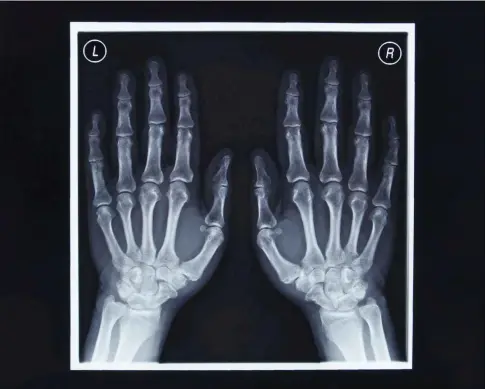  ?? Foto: imago/Steinach ?? Eine Möglichkei­t, das Alter eines Menschen ungefähr zu bestimmen, ist die Auswertung von Röntgenbil­dern.