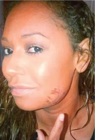  ??  ?? Injuries: Mel B claims Belafonte assaulted her, then forced her to post this picture online saying she had hurt herself when running in heels