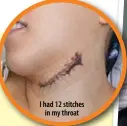  ??  ?? I had 12 stitches
in my throat