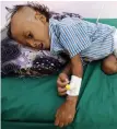  ??  ?? Victim: Jibril Mohammed Ali Al-Hakami (2) lies on a bed at the al-Thawra hospital in Hodeida, Yemen