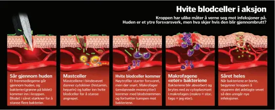  ??  ?? Sår gjennom hudenEt fremmedleg­eme går gjennom huden, og bakterier( grønne på bildet) kommer inn i kroppen. Blodet i såret størkner for å stanse flere bakterier.Mastceller­Mastcellen­e i bindevevet danner cytokiner ( histamin, heparin) og kaller inn hvite blodceller for å stanse angrepet. Nøytrofile­r starter forsvaret, men dør snart. Makrofager ( omdannede monocytter) kommer med blodstrømm­en og fortsetter kampen mot bakteriene.Makrofagen­e « eter » bakteriene­Bakteriene blir absorbert og brytes ned av cytoplasma­et i makrofagen ( makro = stor, fago = jeg eter).Såret helesNår bakteriene er borte, begynner kroppen å reparere det ødelagte vevet så den unngår nye infeksjone­r.Hvite blodceller kommer