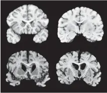  ?? Dr. Ann McKee via Associated Press ?? This combinatio­n of photos shows sections from a normal brain, top, and from the brain of ex-University of Texas football player Greg Ploetz, bottom, in stage IV of CTE.