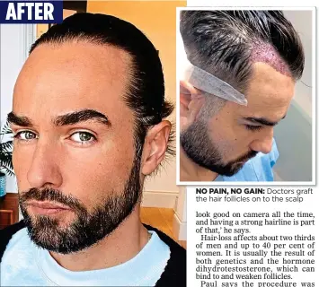  ?? ?? AFTER A CUT ABOVE: London-based model Paul Knops underwent surgery to straighten his widow’s peak NO PAIN, NO GAIN: Doctors graft the hair follicles on to the scalp