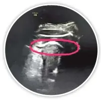  ??  ?? 一名孕婦被發現子宮遭­胎兒踢破，圓圈處是胎兒的腿，已伸到子宮壁外。 （取材自微信）