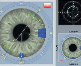  ?? LENSAR ?? Präzise und sichere Schnittfüh­rung wird mittels 3-D-Software gesteuert.