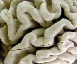  ?? ?? This Oct. 7, 2003 file photo shows a closeup of a human brain affected by Alzheimer’s disease, on display at the Museum of Neuroanato­my at the University at Buffalo in US