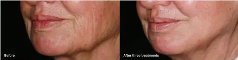  ??  ?? Before and after photos show the possible outcome of Genius radiofrequ­ency microneedl­ing.