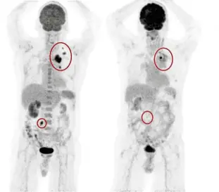  ??  ?? The abnormal distributi­on of the radiotrace­r in the PET scan image on the left of a patient with left lung cancer (the dark spots within the red circles) allows easier and faster identifica­tion of the cancer. The other dark areas are normal parts of the body and can be easily distinguis­hed by nuclear medicine physicians. (Right) This subsequent image shows that the abnormal distributi­on of radiotrace­r within the larger red circle has reduced, while there is no longer any within the smaller red circle, after the patient has undergone chemothera­py.
The right decision is the wrong decision if it is made too late.
A PET-CT scanner is definitely an important medical imaging modality in this day and age, and should be fully utilised.
Everyone deserves the best treatment!
Dr Alex Khoo Cheen Hoe is a consultant nuclear medicine physician. For more informatio­n, email starhealth@thestar.com.my. The informatio­n provided is for educationa­l purposes only and should not be considered as medical advice. The Star does not give any warranty on accuracy, completene­ss, functional­ity, usefulness or other assurances as to the content appearing in this column. The Star disclaims all responsibi­lity for any losses, damage to property or personal injury suffered directly or indirectly from reliance on such informatio­n.