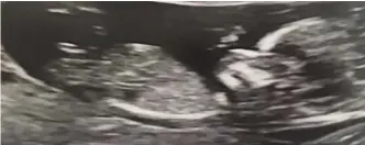  ??  ?? ‘Our angel’: Ultrasound scan of Logan shown to the hearing by his parents
