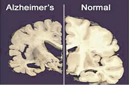  ?? THE ASSOCIATED PRESS/FILES ?? These photos from Merck & Co. show brains in cross-section. On the left is a brain afflicted with Alzheimer’s disease while the image on the right is of a normal brain.