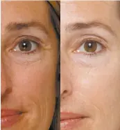  ??  ?? Before and After from 4-Week Study Above. Remarkably, these results were achieved using a special form of marine collagen found in Eslor Collagen Day Cream, not Botox ® or any other skin tightening treatment. The cosmetic is a quarter of the cost.