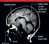  ??  ?? Long-term alcohol intake
could restrict neuron developmen­t, so the baby is born with a smaller brain and permanent brain injury. Fewer folds on the surface of the brain. Smaller head Fewer brain cells Flat face