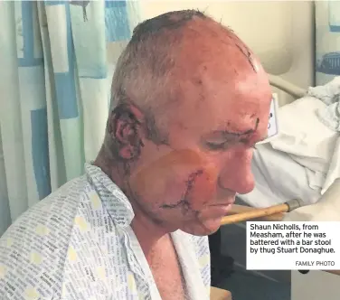  ?? FAMILY PHOTO ?? Shaun Nicholls, from Measham, after he was battered with a bar stool by thug Stuart Donaghue.