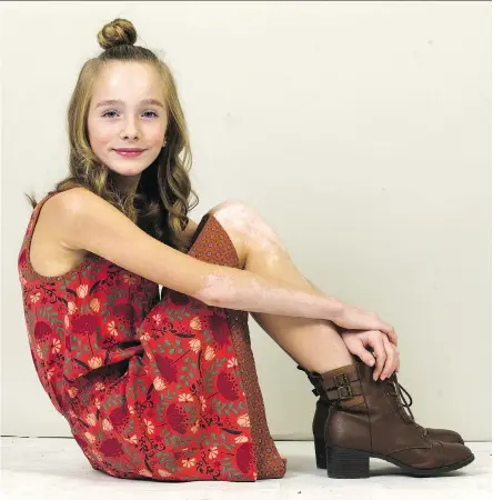  ??  ?? Ava Bright, a model from London, Ont., has a condition called vitiligo. But rather than slowing her down, the 11-year-old is using it to her advantage.