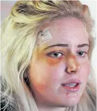  ??  ?? RECOVERING: Sanet de Lange sustained a gash to her temple and had to have scans to check for damage to her head.