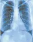  ??  ?? A lung x-ray.