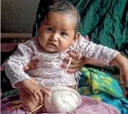  ??  ?? Nine-month-old Krish Bista being held by his mother Parbati Bista in Kanti Children’s Hospital. His legs were amputated due to severe burns.