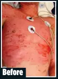  ??  ?? This man suffered extensive burns after he touched a live electrical wire Before SEVERE: