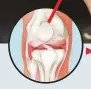  ??  ?? Knee joint with arthritis