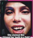  ??  ?? She claimed Mel chipped her tooth in a fight