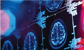  ?? Photograph: Image Source/Alamy ?? Human brain scan in a neurology clinic.
