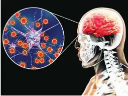  ?? DREAMSTIME ?? La meningitis es una inflamació­n de las membranas (meninges)