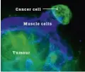  ??  ?? Muscle cells capture an escaped cancer cell and pull it back to the cancer tumour.