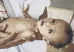 ??  ?? 0 A baby suffering from acute severe malnutriti­on in Yemen