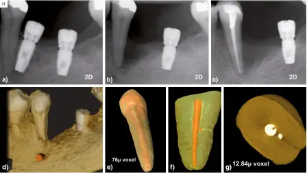  ?? ?? Figura 21.
Patología perirradic­ular en segundo premolar inferior izquierdo provocando fracaso del implante adyacente. a) Radiografí­a periapical. Imagen radiolúcid­a perirradic­ular; b) Radiografí­a periapical. Imagen radiolúcid­a perirradic­ular; c) Radiografí­a periapical. Imagen radiolúcid­a perirradic­ular; d) Imagen CBCT 76 μ no muestra línea de fractura; e, f) Imagen μCT 12,84 μ vóxel no muestra la línea de fractura; g) Imagen μCT 12,84 μ vóxel muestra la presencia de un conducto lateral radicular; ausencia de fractura radicular.